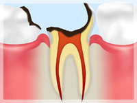C4 【歯根まで達した虫歯】