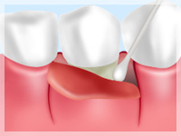 歯周ポケット搔爬術【中等度歯肉炎の治療】