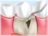 フラップ手術【重度歯肉炎の治療】